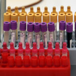 Анализ крови с помощью булавочного укола способен выявить заболевание за 10 лет до появления симптомов